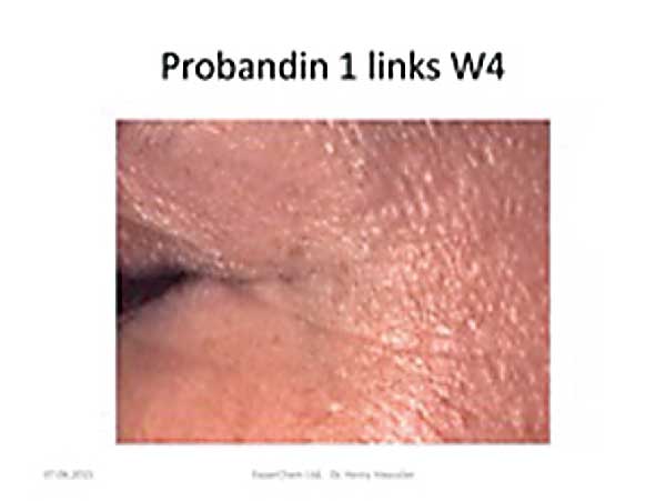 Die Haut neben dem linken Auge einer Probandin nach vier Wochen der Behandlung. Die Haut ist merklich gesünder.