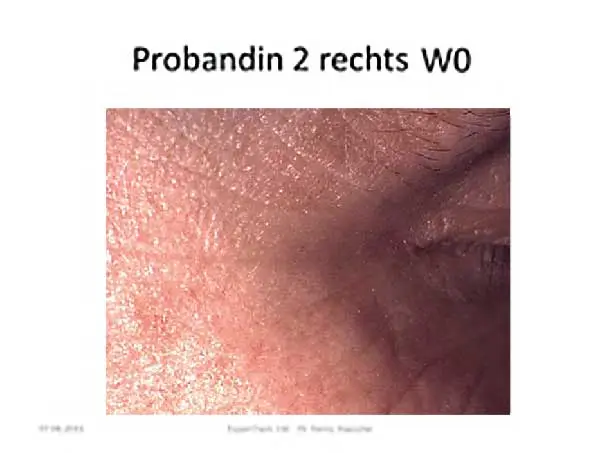 Die Haut neben dem rechten Auge einer Probandin vor der Behandlung