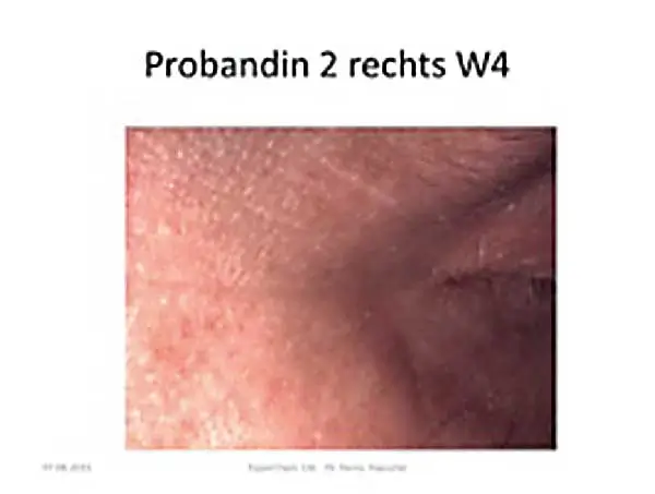 Die Haut neben dem rechten Auge einer Probandin nach vier Wochen der Behandlung. Die Haut ist merklich gesünder.